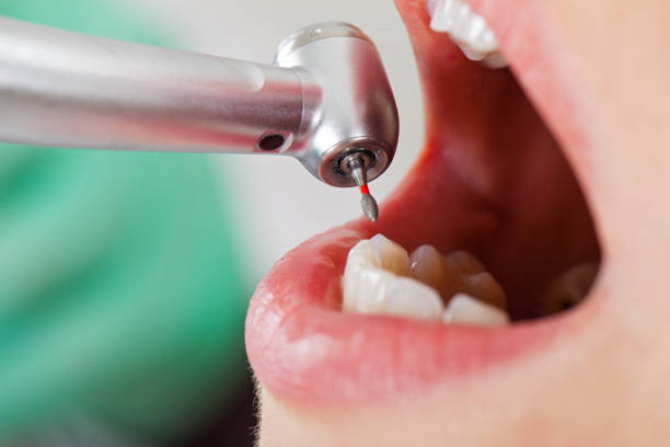 Best Dental Abscess Treatment in Pearl River, NY